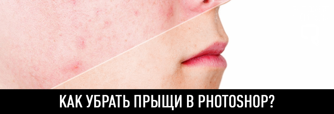 Как на голове убрать прыщи Как на голове убрать прыщи